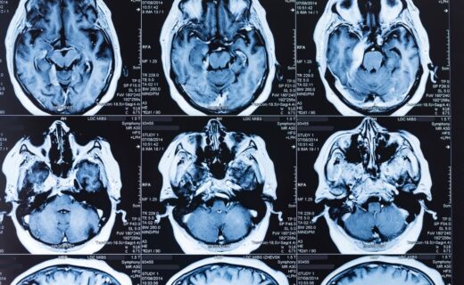 Brain cancer breakthrough as scientists find 'window' to attack tumours after surgery