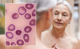 Pharmacist warns of seven anaemia signs missed by millions of Britons — including changes to nails and skin