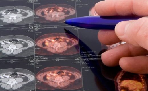 Prostate cancer warning as one diagnosis made every eight minutes
