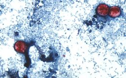 One in three Britons hit by travel bug as cyclosporiasis outbreak turns deadly in the US