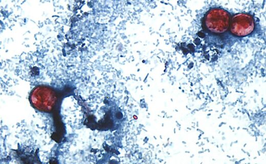 One in three Britons hit by travel bug as cyclosporiasis outbreak turns deadly in the US